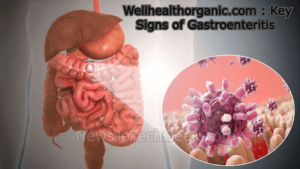 WellHealthOrganic.com Key Signs of Gastroenteritis